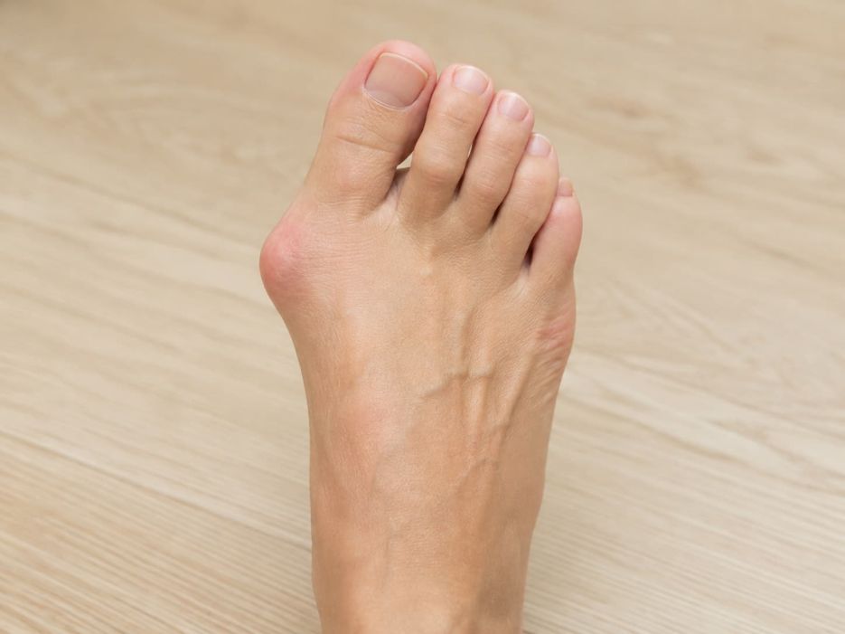 Hallux valgus